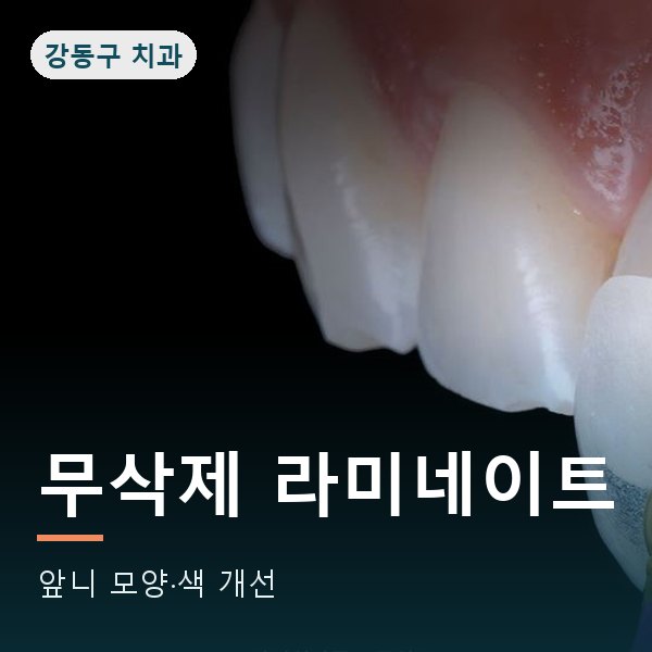 무삭제 라미네이트